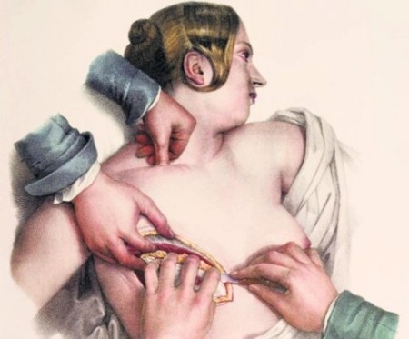 ,XIX-wieczny-sztych-przedstawiajacy-operacje-odjecia piersi